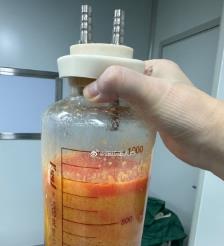 贵州水动力吸脂手术要做多久？